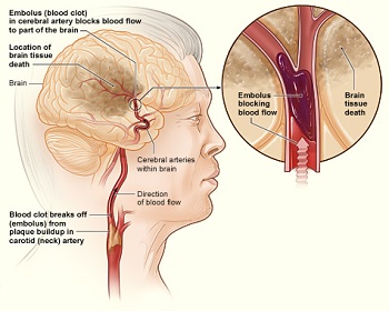 Accidente cerebrovascular isquémico