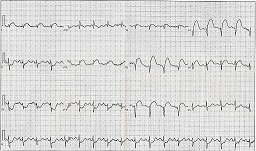 Ejemplo de una prueba de ECG
