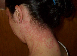 La erupción cutánea es un síntoma de alergia.