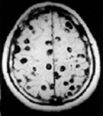 Neurocisticercosis, cisticercosis del cerebro. Los agujeros negros en esta resonancia magnética representan cisticercos.