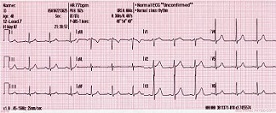 Un ECG de 12 derivaciones para determinar mejor las arritmias