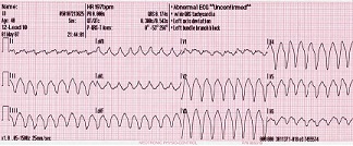 Ejemplo de taquicardia ventricular, una arritmia cardíaca potencialmente mortal