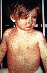 Niño con sarampión