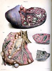 Tuberculosis