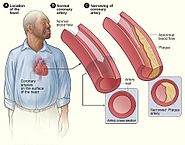 Aterosclerosis