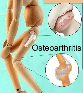 osteoartritis