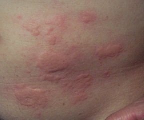 urticaria