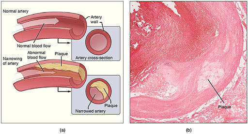 aterosclerosis