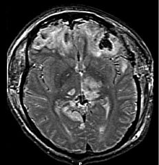 Los signos y síntomas de los trastornos cerebrales adquiridos se deben a cambios perjudiciales en la estructura y función del cerebro.