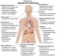 Infecciones bacterianas
