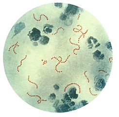 Las cadenas rojas en esta imagen representan estreptococos beta-hemolíticos del grupo A tal como se visualizan al microscopio.