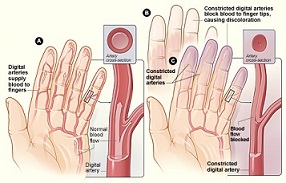 Ejemplo de fenómeno de Raynaud debido a vasos sanguíneos constreñidos