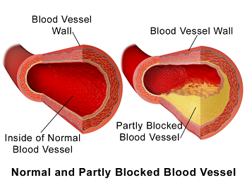 arteriosclerosis