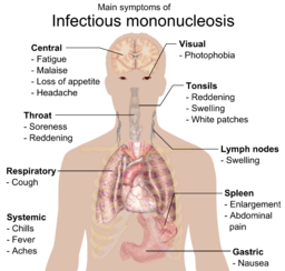 mononucleosis