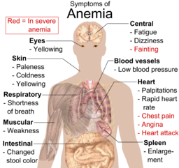 síntomas de anemia