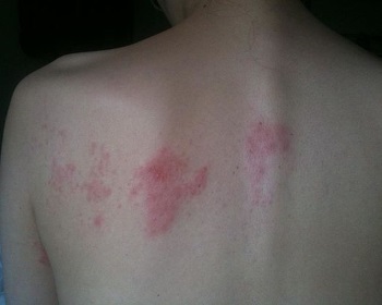 erupción de herpes zóster