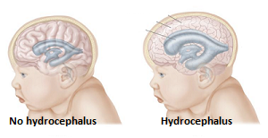 La hidrocefalia puede requerir neurocirugía.