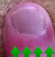 El dedo gordo del pie enrojecido e hinchado de un paciente con gota.