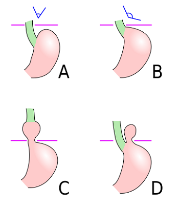 Hernias de hiato
