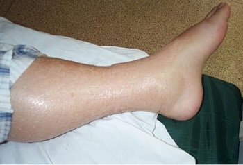 edema
