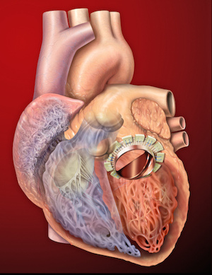 válvula mitral artificial