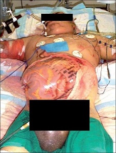 Descompresión quirúrgica por laparotomía