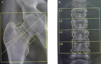 Escaneo DEXA