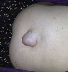 Una hernia umbilical que sobresale del ombligo.