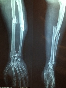 fractura