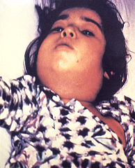 Un niño afectado por difteria