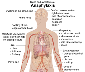 Signos y síntomas de anafilaxia
