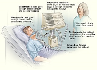 Gestión de ventilación mecánica