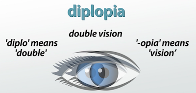 diplopía