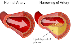 aterosclerosis