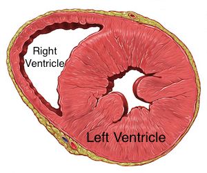 Hipertrofia del ventrículo izquierdo