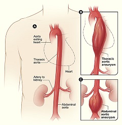 Aneurismas torácicos y abdominales