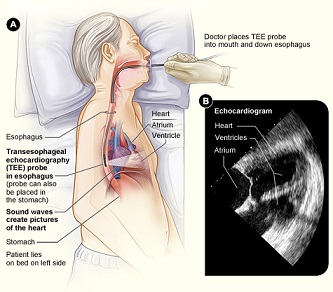 ecocardiograma transesofágico