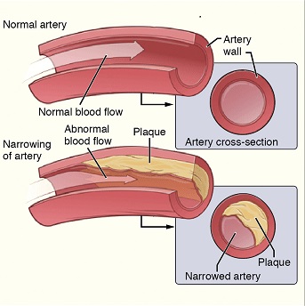 aterosclerosis