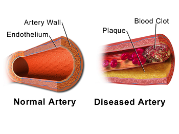 aterosclerosis