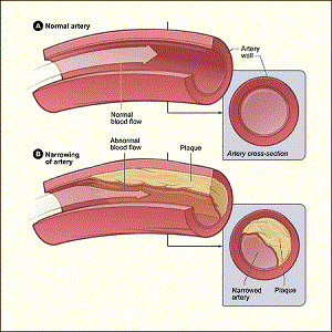 aterosclerosis