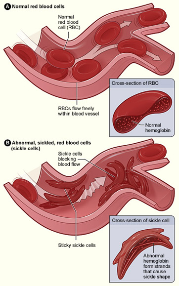 Diagrama de células falciformes y vasos sanguíneos.
