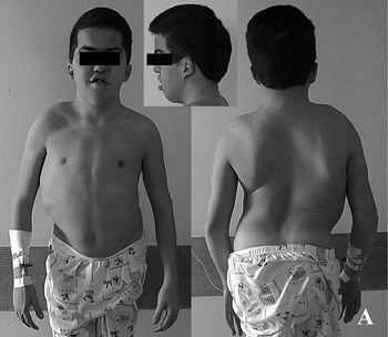 crecimiento óseo anormal