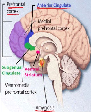 Estructura cerebral anormal en una persona con trastorno límite de la personalidad.
