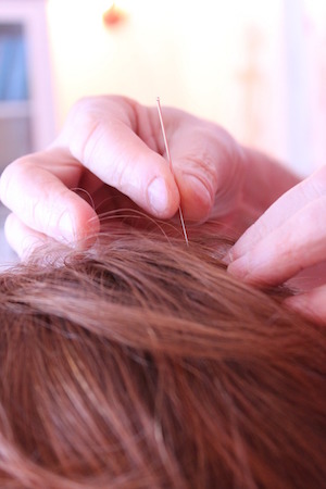 acupuntura