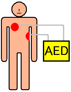Colocación automática de la almohadilla de desfibrilador externo