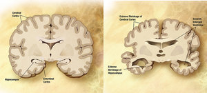 Alzheimer