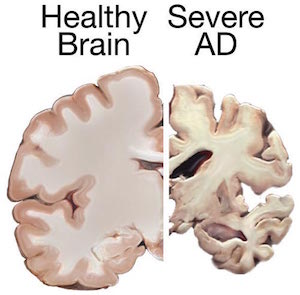 Cerebro de la enfermedad de Alzheimer