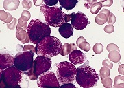 Glóbulos blancos aumentados y anormales como se ve en la leucemia