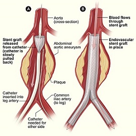 Reparación endovascular