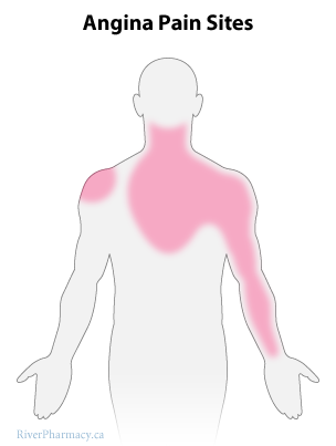 Diagrama de sitios de dolor 